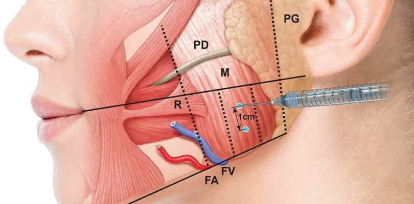 Masseter (Teeth Grinding) Botox