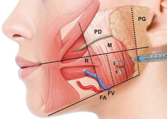 Masseter (Diş Sıkma) Botoksu